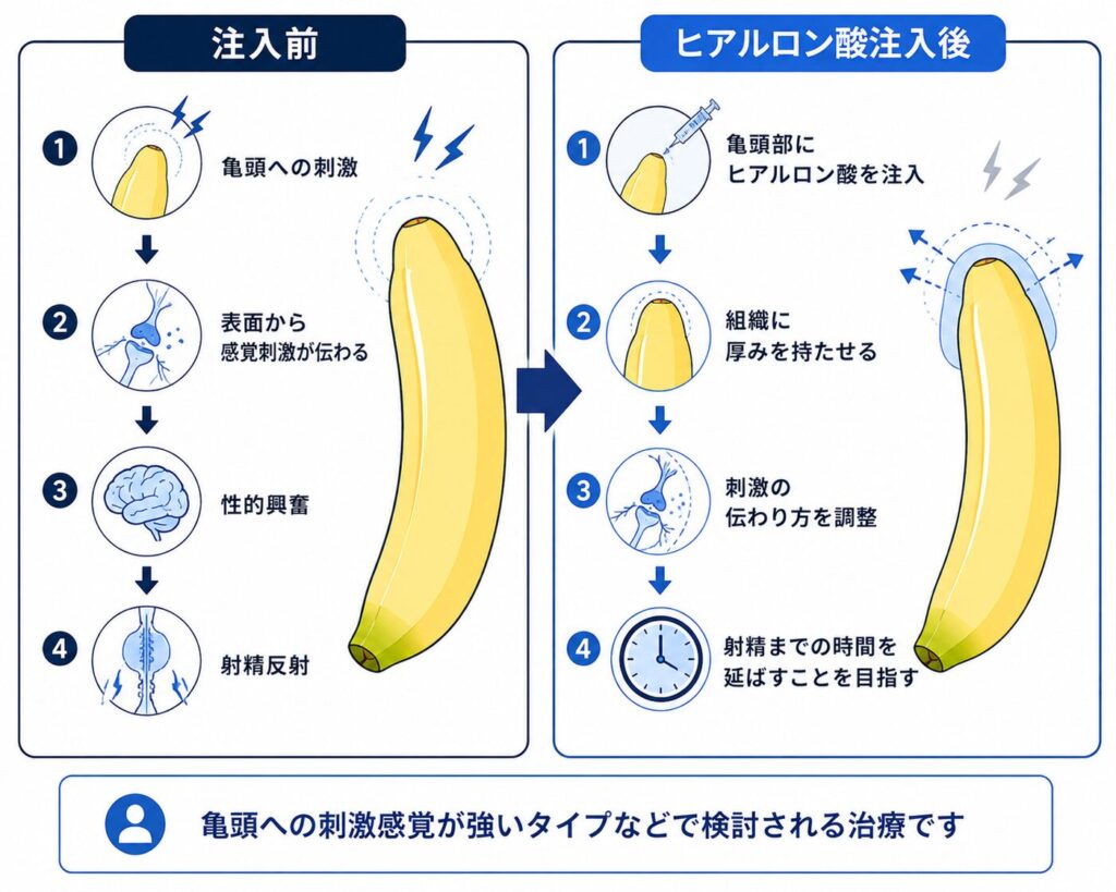 亀頭ヒアルロン酸注入によって組織に厚みを持たせ刺激感覚を調整する仕組み