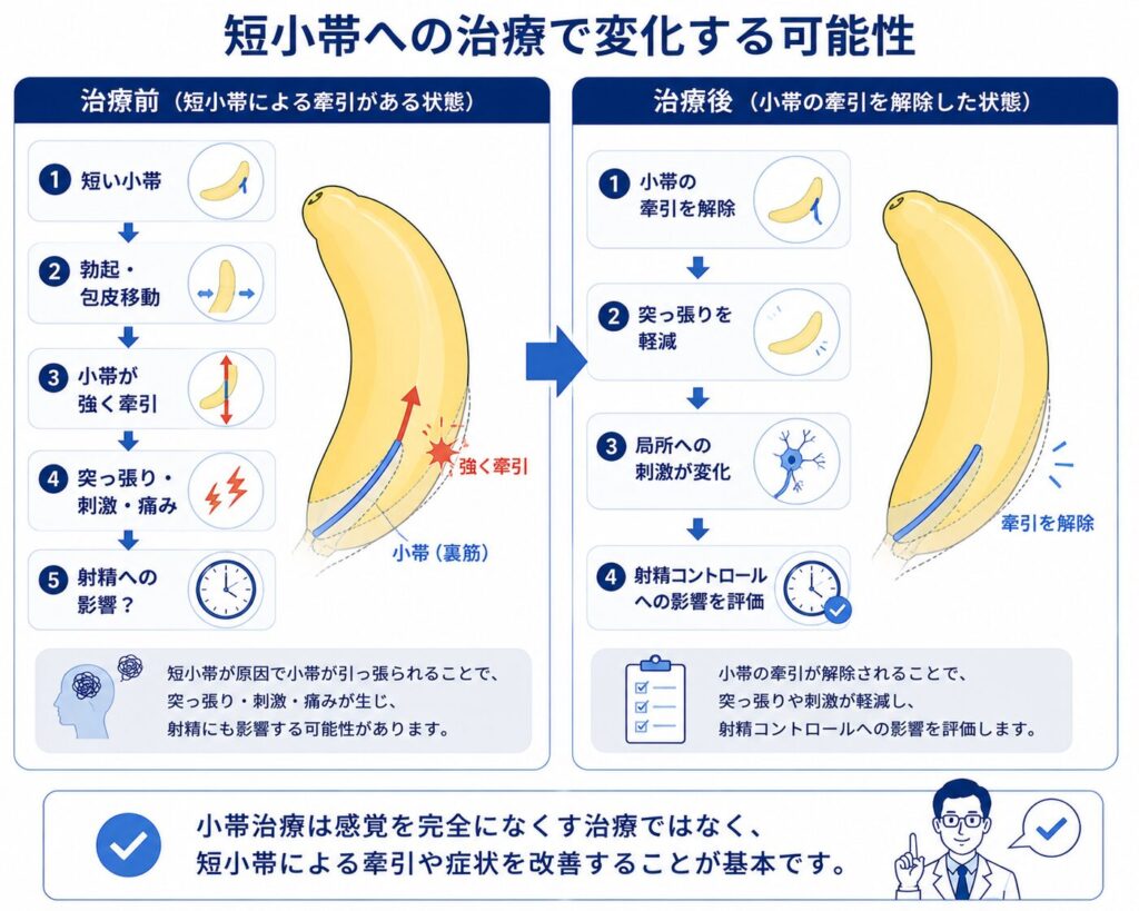 短小帯による陰茎小帯の牽引と小帯治療後の刺激・突っ張りの変化を比較する図